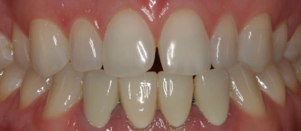 Before